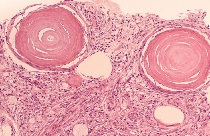 Meningioma